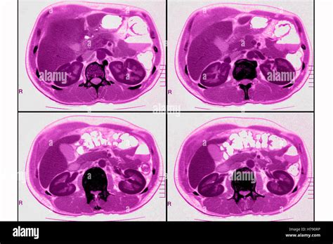Computed tomography abdomen Banque de photographies et dimages à haute