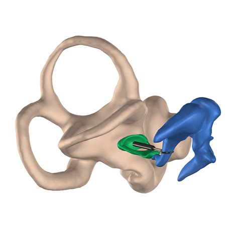 Stapedotomy | ENT Care Sydney