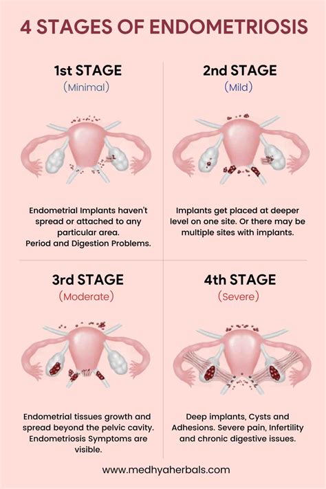 Endometriosis Symptoms 5 Early Signs You Shouldn T Ignore