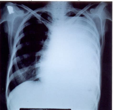 Hydropneumothorax X Ray