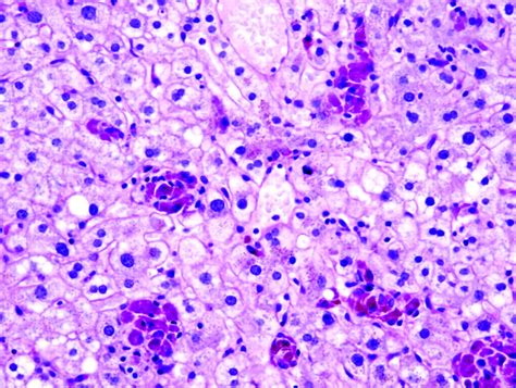 Histological Patterns In Drug Induced Liver Disease Journal Of Clinical Pathology