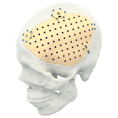 Personalized PEEK Titanium Patient Specific Implant For Cranial