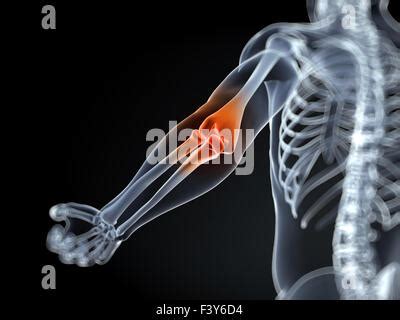 Elbow Bursitis Illustration Stock Photo Alamy