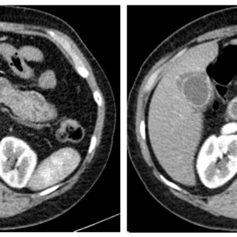 CT examination (pancreatic phase) of ductal adenocarcinoma of the... | Download Scientific Diagram