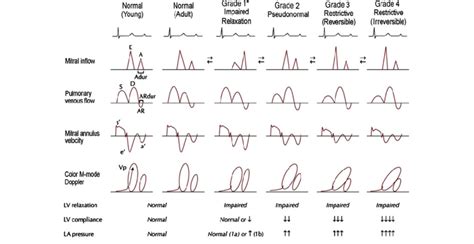 Grades Of Diastolic Function The Doppler Echocardiography Measures