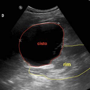Cistos Renais Dica M Dica