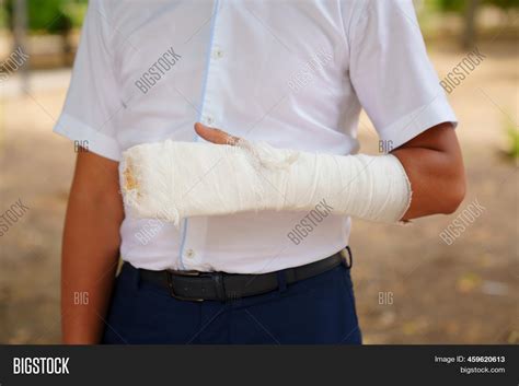 Man Broken Arm Cast Image And Photo Free Trial Bigstock