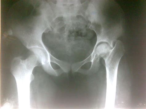 Femoral Neck Fracture Symptoms Luckklim