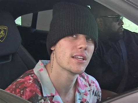 Justin Bieber Battling Lyme Disease Reveals Chronic Mono Too