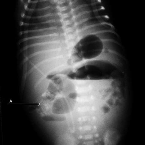 Prenatal Ultrasound Intraabdominal Calcifications With Meconium