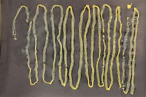 Huge 9ft Tapeworm Removed From A Man In Singapore