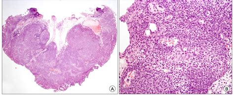 Figure 2 From A Case Of Early Stage Squamous Cell Carcinoma Of The Anal Canal Diagnosed By