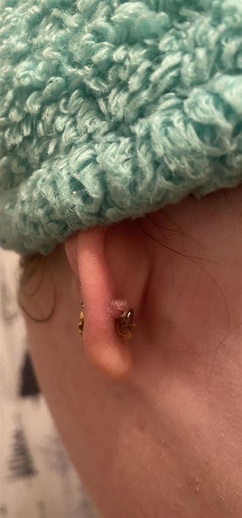 Irritation Bump R Piercing