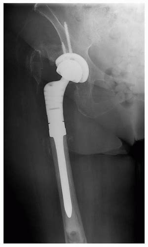 Proximal Femoral Replacement