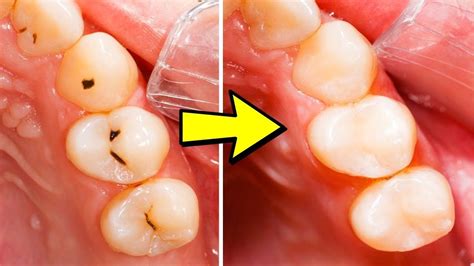 Follow This 5 Steps To Heal Your Tooth Decay And Reverse Cavities