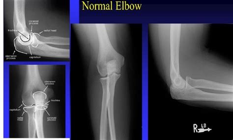 Elbow Pathology Flashcards Quizlet