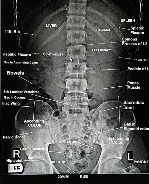 Abdomen Anatomy X Ray Ap View In 2024 Medical Radiography Radiology Imaging Medical Anatomy