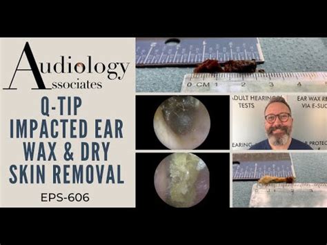 Q Tip Impacted Ear Wax Dry Skin Removal Ep Youtube