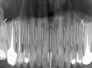 method  cutting  upper    teeth  starting