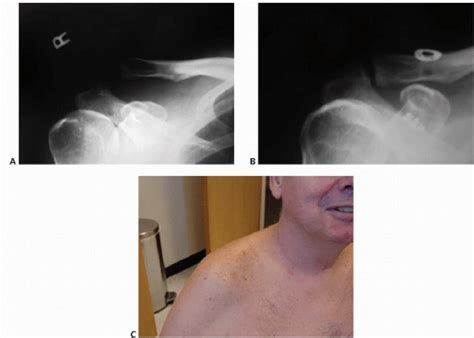 Acromioclavicular Separations Arthroscopic Reconstruction Of The