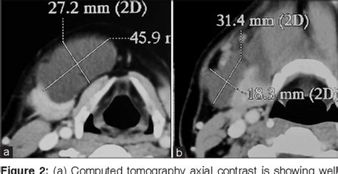 Figure 2 From Adult Onset Cystic Hygroma A Case Report Of Rare Entity Semantic Scholar