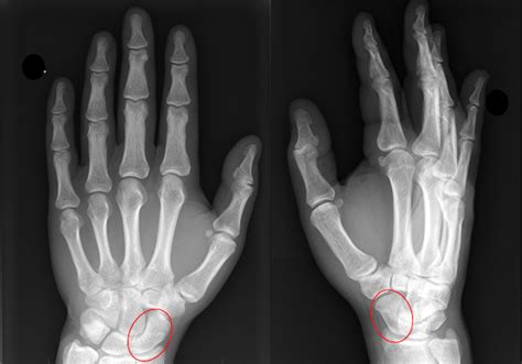 Scaphoid Fracture