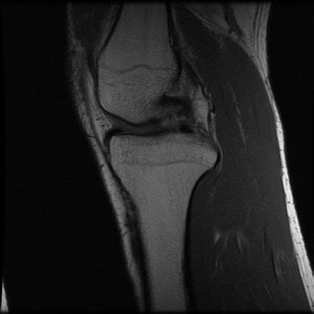 Symptomatic Benign Osteochondroma Image Radiopaedia Org