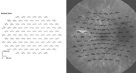 A Tapetal Like Fundus Reflex In A Healthy Male Evidence Against A Role