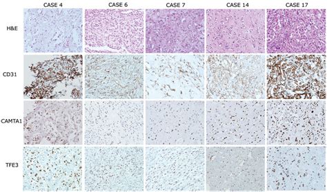 Histological Features And Immunohistochemical Expression Profiles Of