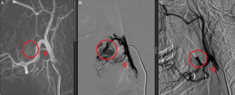 The Impact Of Trans Arterial Embolization On The Result Of