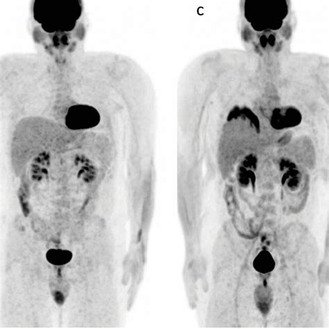 CMR On IPET EoT PET Baseline MIP FDG PET A In A 26year Male