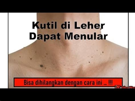 KUTIL DI LEHER Cara Cepat Dan Ampuh Menghilangkan Kutil Di Leher