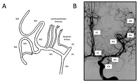 Middle Cerebral Artery Angiogram