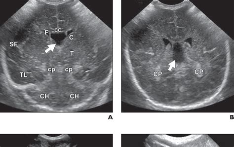 Figure 2 From State Of The Art Cranial Sonography Part 2 Pitfalls And Variants Semantic Scholar