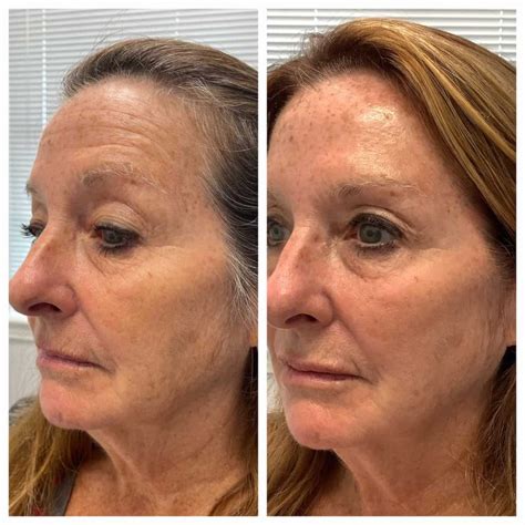 Comprehensive Facial Rejuvenation Before And After St Louis