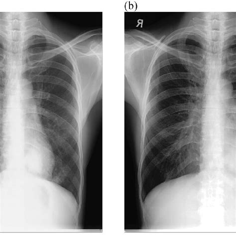 Low Kvp Chest Radiograph A Original Image And B Processed Image By