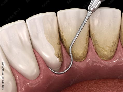 Oral Hygiene Scaling And Root Planing Conventional Periodontal Therapy Medically Accurate 3d