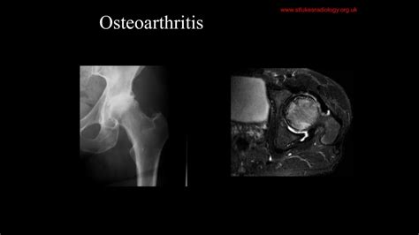 Imaging Osteonecrosis Youtube