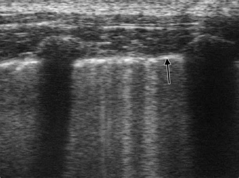 Pleura Radiology Key