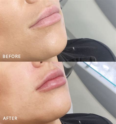 Aftercare Tips And Instructions For Your Lip Filler Procedure With