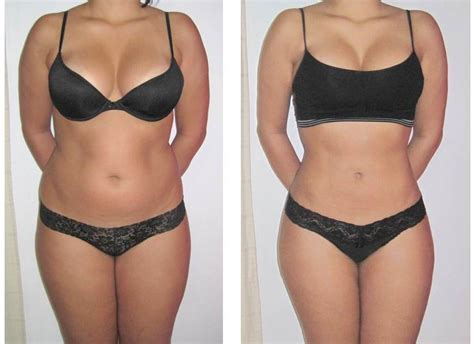 Strawberry Laser Lipo Non Invasive Liposuction Coolsculping Denver