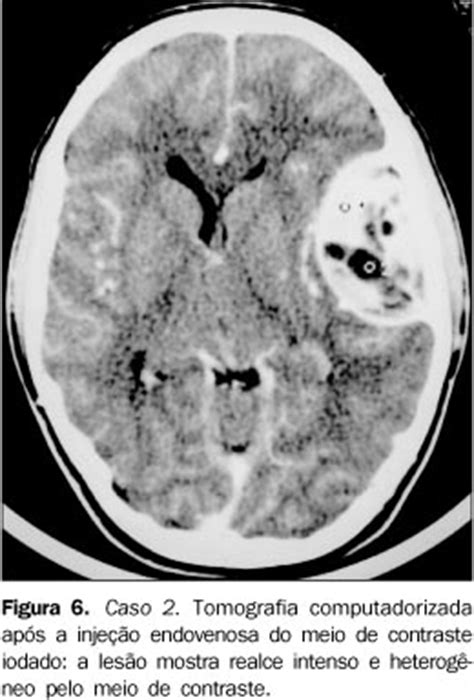 SciELO Brasil Tumores ósseos raros da calota craniana sarcoma de