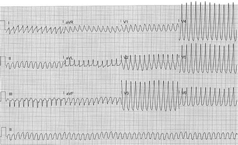 Ecg Challenge February March Emra