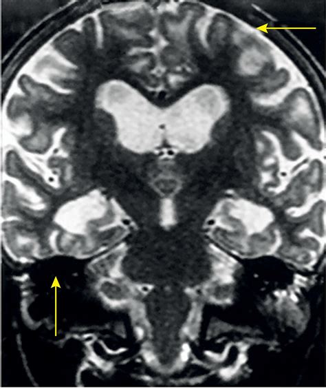 Late Onset Congenital Syphilis With Unusual Brain Abnormalities