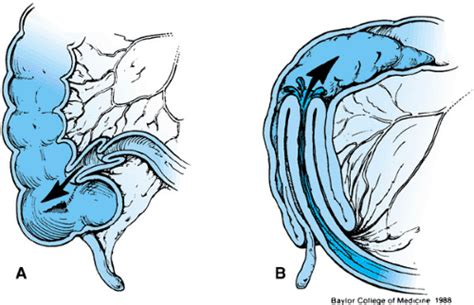 Intussusception Musculoskeletal Key