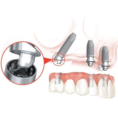 New Nobel Biocare Multi Unit Abutment Plus
