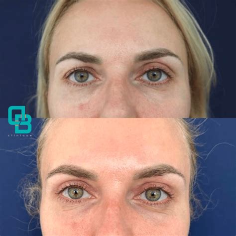 Blefaroplastie Chirurgicala Superioara Operatie Pleoape Cazute