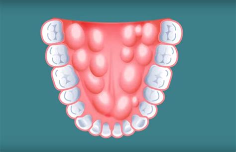 Maxillary And Mandibular Tori