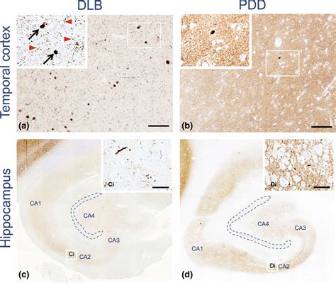 Clinical And Neuropathological Differences Between Parkinsons Disease