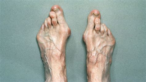 Marfan Syndrome Face